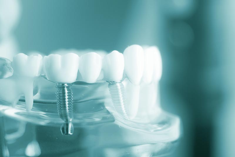 Dental implants